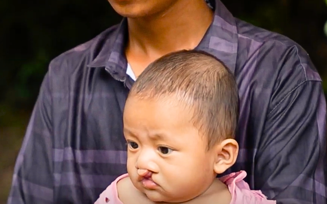 Born With Cleft Lip In Cambodia: A Journey of Peace