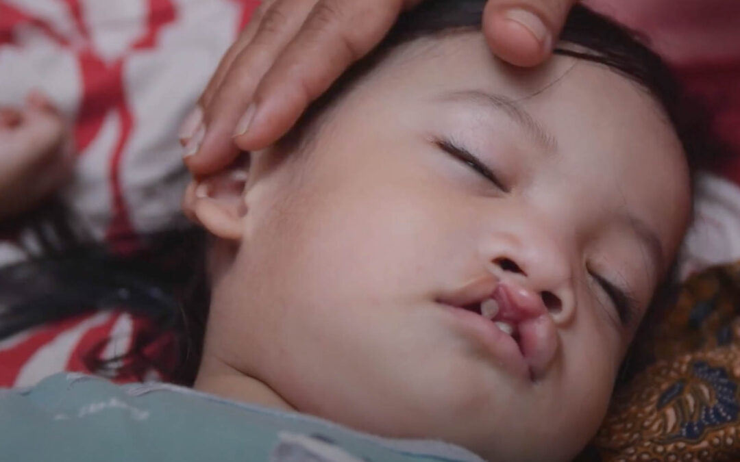 Transforming Lives through Cleft Surgery in Indonesia
