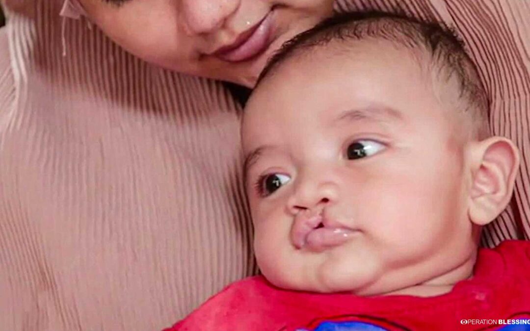 A Path to Healing from a Cleft Lip in Indonesia