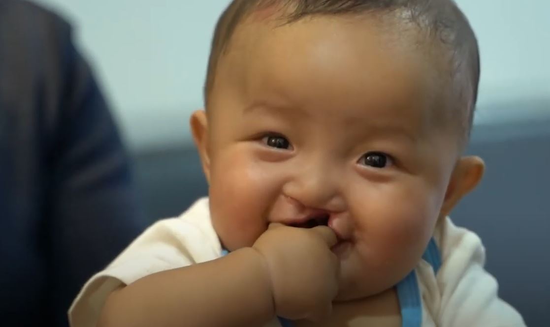 operation-blessing-cleft-lip-for-baby-boy-in-cambodia