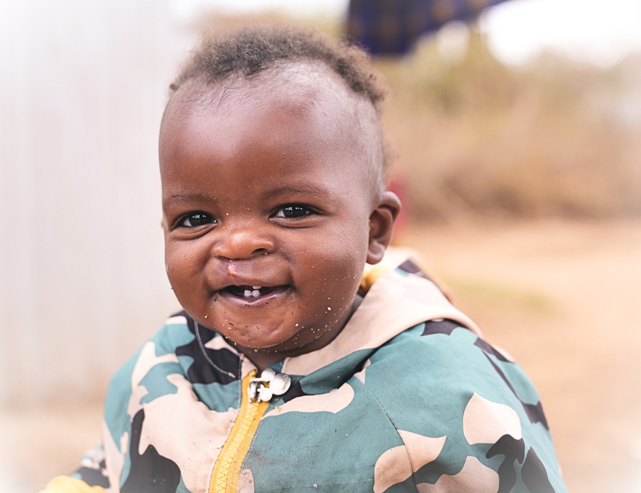 overcoming cleft lip overcoming cleft lip